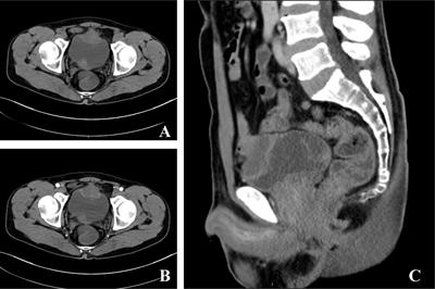 Primary urachal signet ring cell carcinoma: A case report